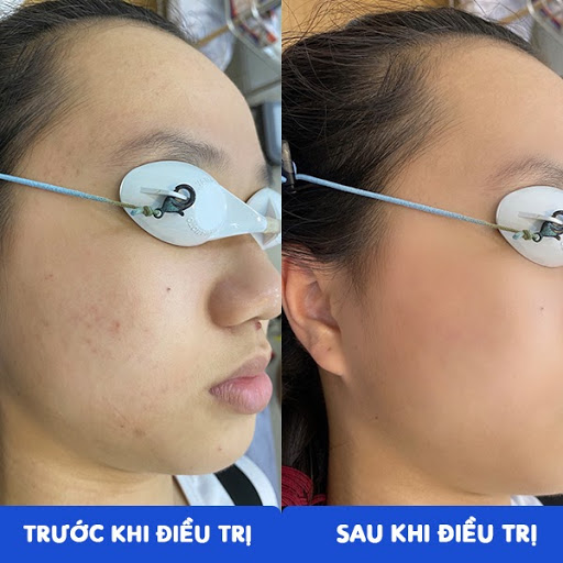 Hình ảnh trước và sau khi điều trị tăng sắc tố da sau viêm mụn (Q – Switch)