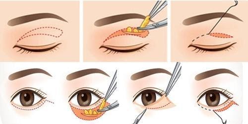 Phương pháp phẫu thuật thẩm mỹ mắt – lấy mỡ mí mắt