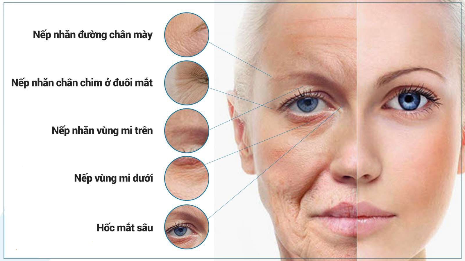 Những vùng thường xóa nhăn vùng mặt dùng tinh chất thư giãn cơ bằng botox